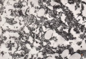 F,33y. | "ground glass" hepatocyte … filamentous inclusions ofhepatitis B surface antigen(HBsA) F,33y. | "ground glass" hepatocyte … filamentous inclusions ofhepatitis B surface antigen(HBsA)